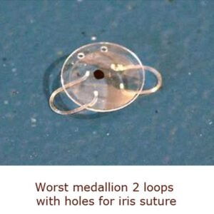 Historic intraocular lens assortment showing Worst medallion 2-loop PMMA IOL with iris suture holes, part of a 48-lens collection documenting early cataract surgery implant history